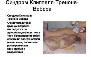 Лечение синдрома клиппеля треноне вебера