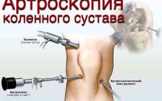 Внутреннее повреждение коленного сустава код по мкб 10