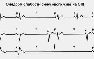 Синдром слабости синусового узла тахи бради