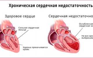 Синдром хронической сердечной недостаточности причины