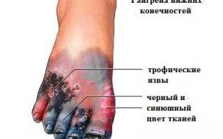 Мкб код гангрена нижних конечностей