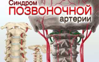 Что капать при синдроме позвоночной артерии
