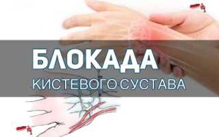 Теносиновит шиловидного отростка лучевой кости синдром де кервена