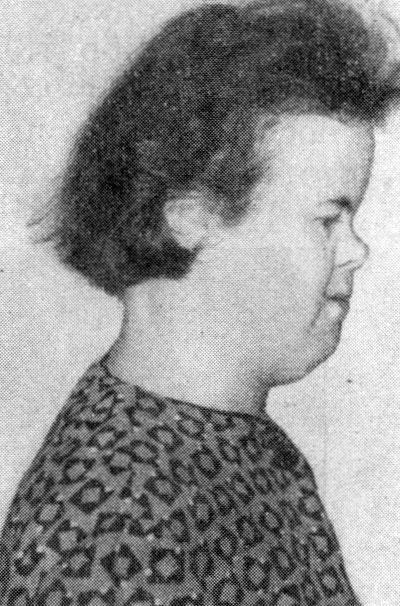 Уплощение спинки носа (больная Н., 27 лет) Уплощение спинки носа (больная Н., 27 лет)