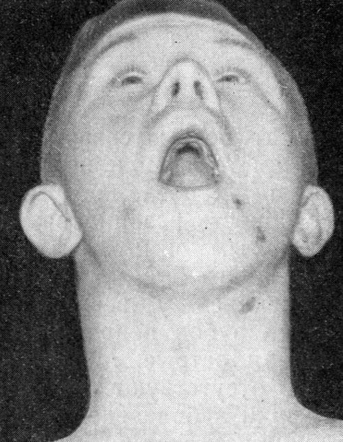 Высокое нёбо (больной А., 17 лет) Высокое нёбо (больной А., 17 лет)