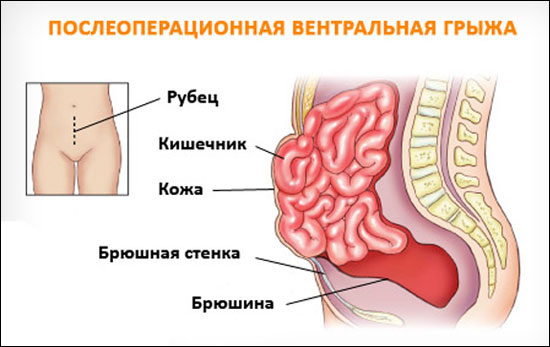 Послеоперационная вентральная грыжа код мкб