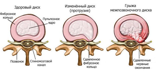 Что такое конский хвост в позвоночнике? Симптомы