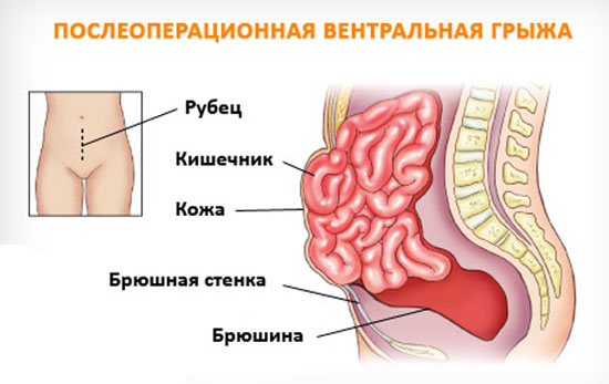 Послеоперационная вентральная грыжа код мкб
