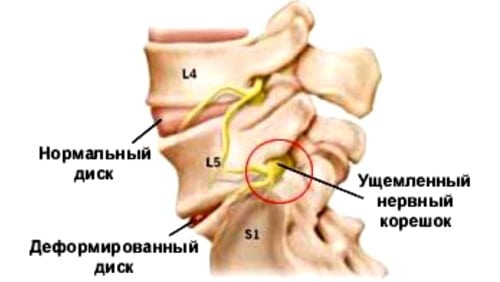 Что такое шейный остеохондроз корешковый синдром