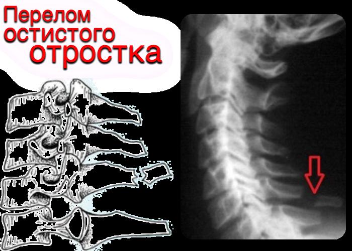 Перелом крестцового позвонка код мкб