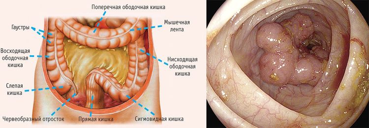 Прямая кишка