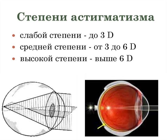 Степени астигматизма