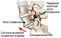 M43.1 Спондилолистез