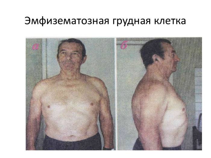 Воронкообразная грудь код мкб
