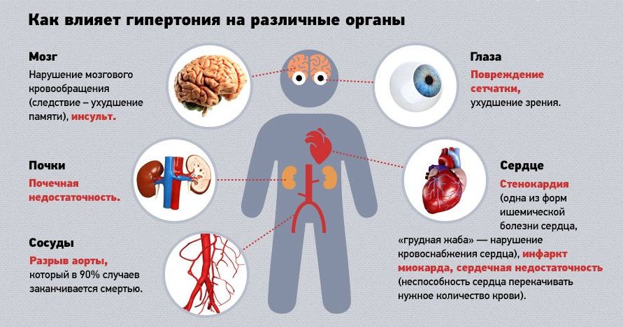 Шифр мкб 10 синдром позвоночной артерии