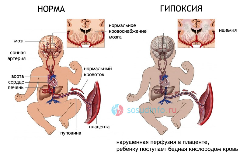 Резидуальная энцефалопатия с цефалгическим синдромом