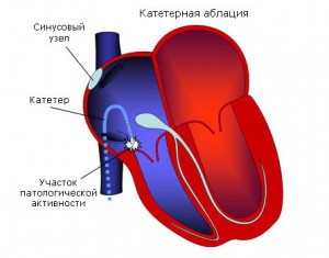 Синдром укорочения pq на экг
