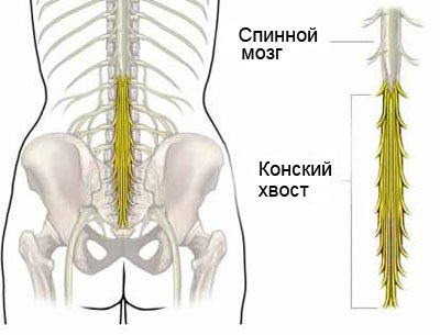 Что такое конский хвост в позвоночнике? Симптомы