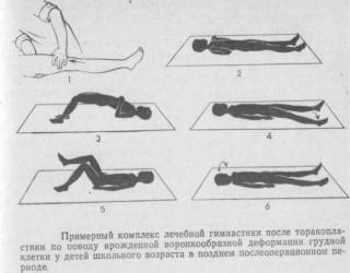 Воронкообразная грудь код мкб