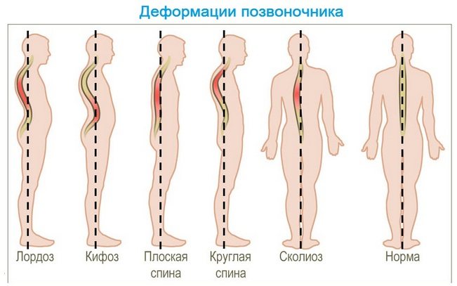 Деформации позвоночника
