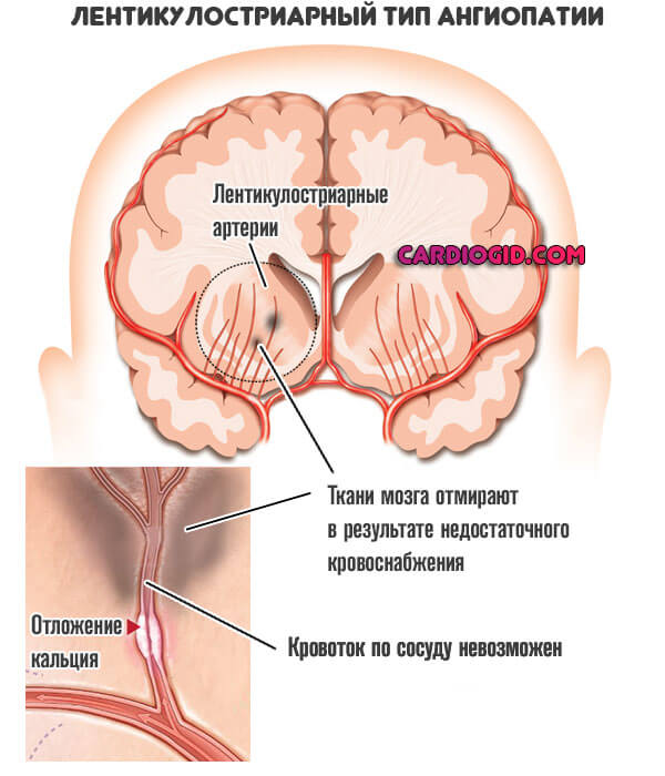 Лентикулостриарный-тип-ангиопатии