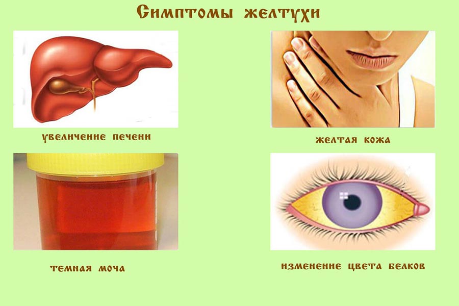Признаки желтухи