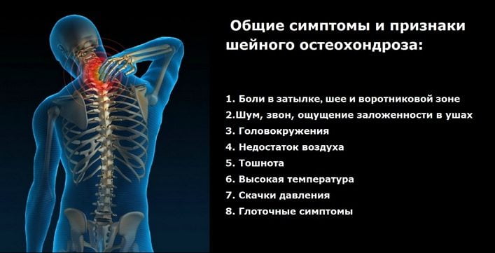 Что такое шейный остеохондроз корешковый синдром