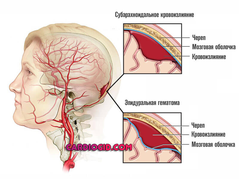 Субарахноидальное-кровоизлияние