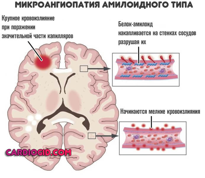 амилоидная ангиопатия