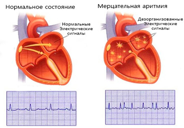 Мерцательная аритмия сердца
