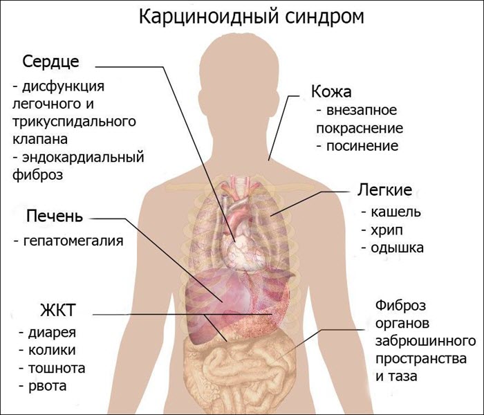 Последствия карциноидного синдрома