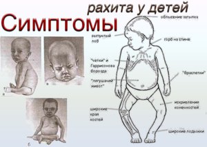 Рахит Заболевание рахит