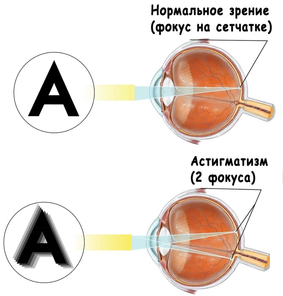 Астигматизм 
