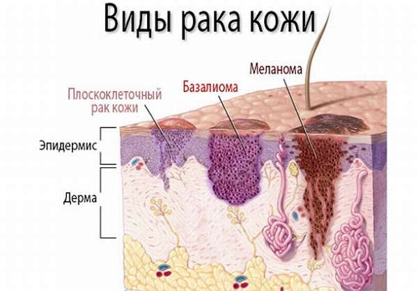 Зно кожи головы код по мкб 10