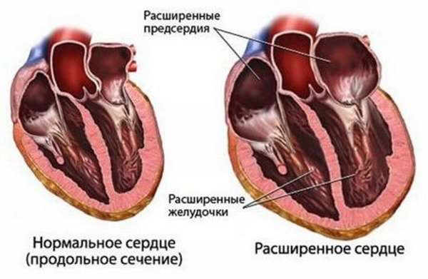 Берут ли в армию с неполной блокадой правой ножки пучка Гиса?