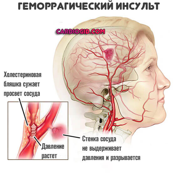 геморрагический-инсульт