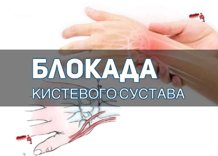 блокада лучезапястного сустава