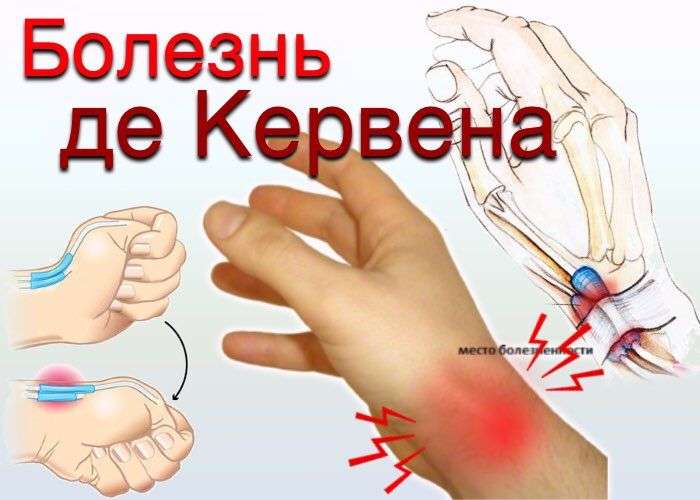 Болезнь де Кервена, боль в кисти
