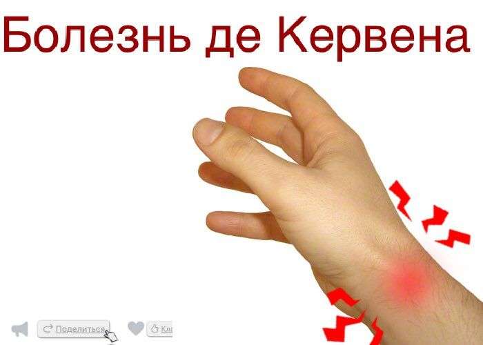 Болезнь де Кервена, боль в кисти