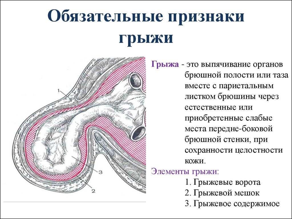 Послеоперационная вентральная грыжа код мкб