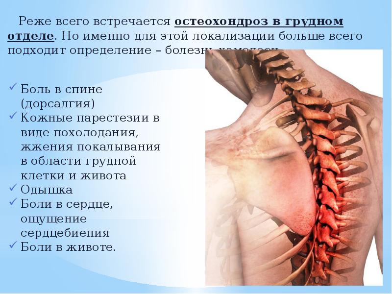Что такое шейный остеохондроз корешковый синдром