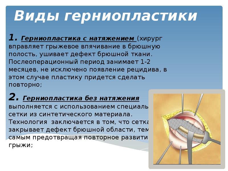 Послеоперационная вентральная грыжа код мкб