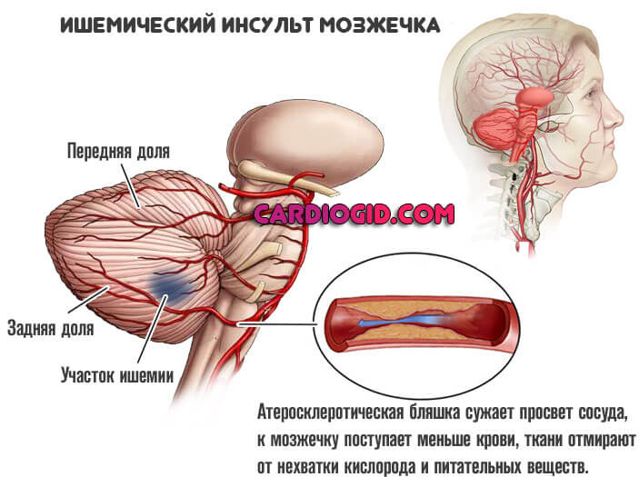 ишемия мозжечка