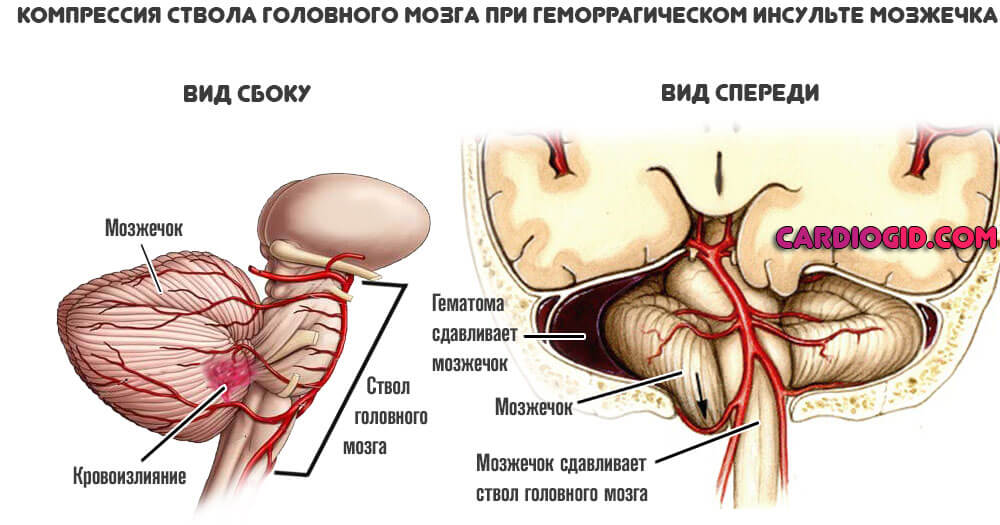 компрессия-ствола-головного-мозга