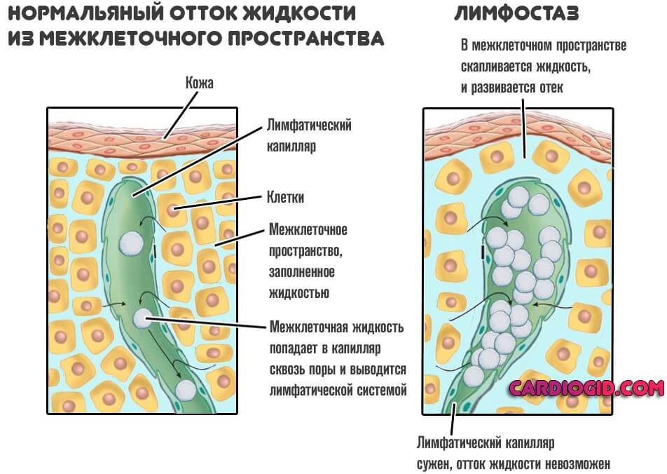 лимфостаз