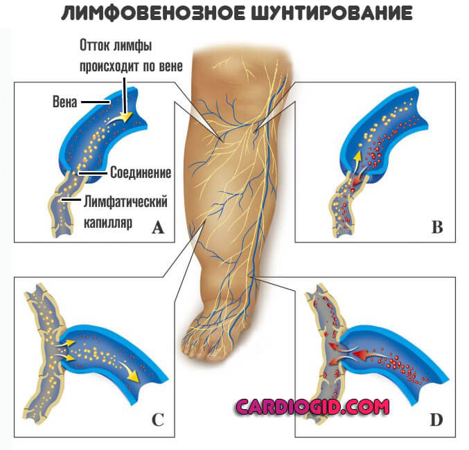 лимфовенозное-шунтирование