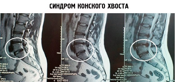 Что такое конский хвост в позвоночнике? Симптомы