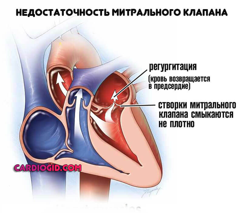 митральная недостаточность