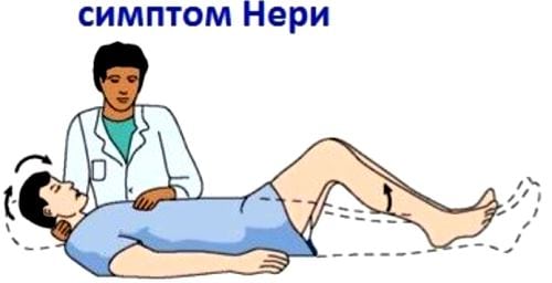 Что такое шейный остеохондроз корешковый синдром