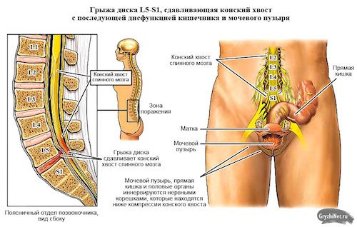Что такое конский хвост в позвоночнике? Симптомы